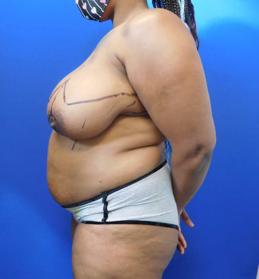 Breast Reduction Patient 02 Before