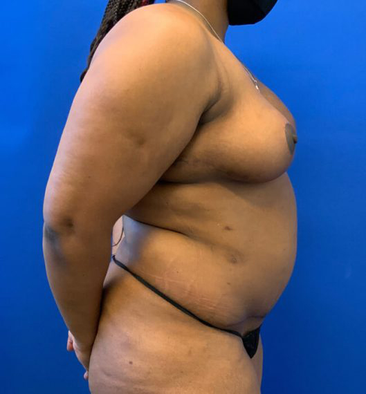 Breast Reduction Patient 02 After