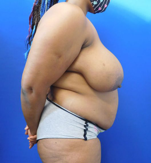 Breast Reduction Patient 02 Before