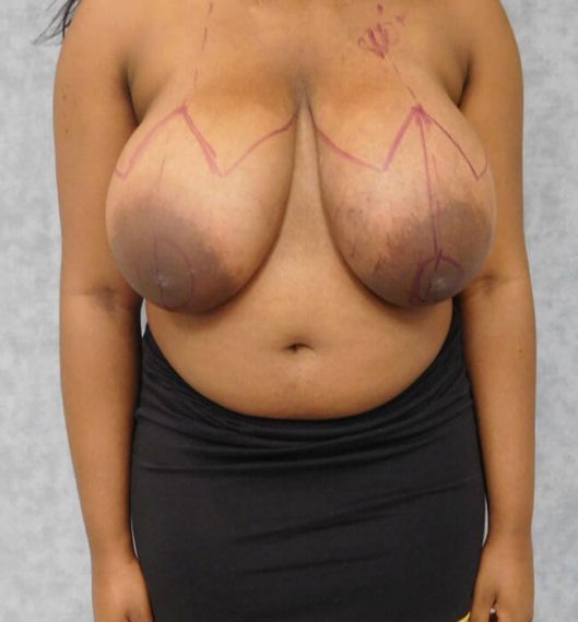 Breast Reduction Patient 03 Before