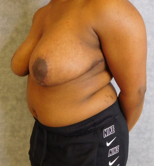 Breast Reduction Patient 03 After