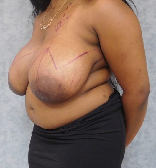 Breast Reduction Patient 03 Before