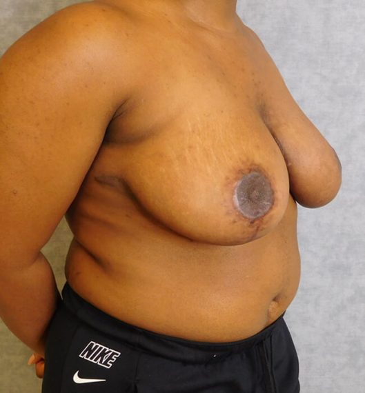 Breast Reduction Patient 03 After