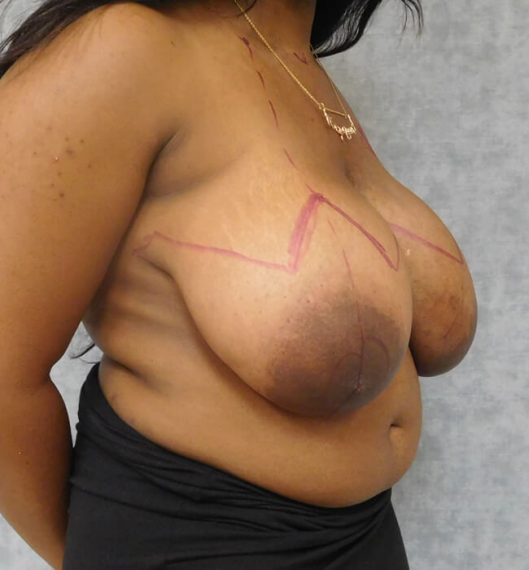 Breast Reduction Patient 03 Before