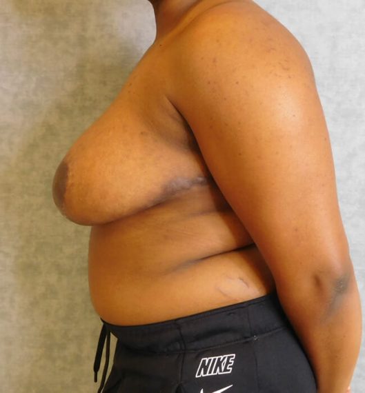 Breast Reduction Patient 03 After