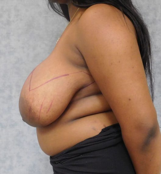 Breast Reduction Patient 03 Before