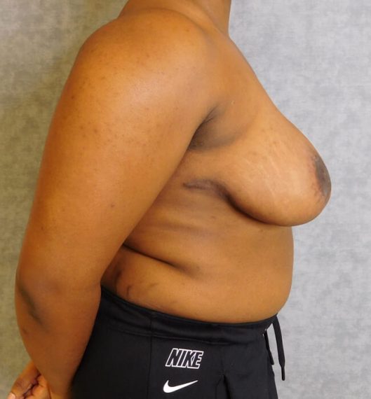 Breast Reduction Patient 03 After