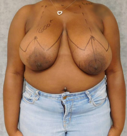 Breast Reduction Patient 04 Before