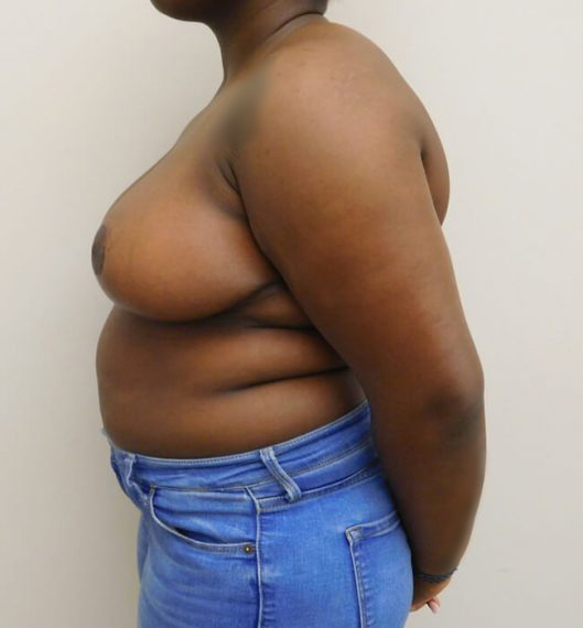 Breast Reduction Patient 04 After