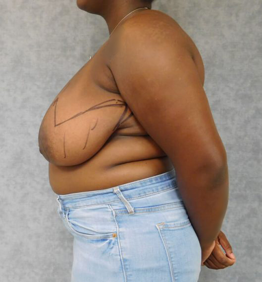 Breast Reduction Patient 04 Before