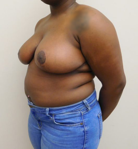 Breast Reduction Patient 04 After