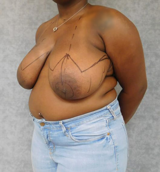 Breast Reduction Patient 04 Before