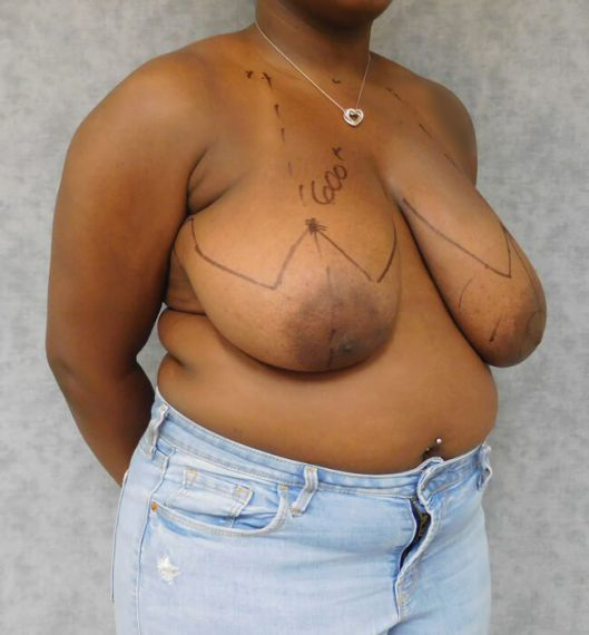 Breast Reduction Patient 04 Before