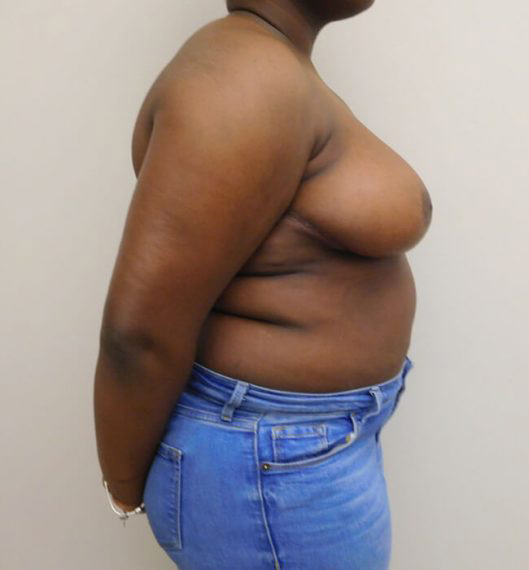 Breast Reduction Patient 04 After