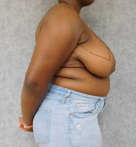 Breast Reduction Patient 04 Before
