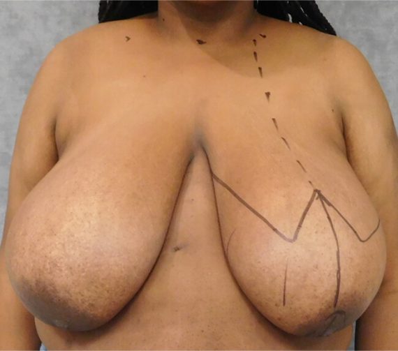 Breast Reduction Patient 05 Before