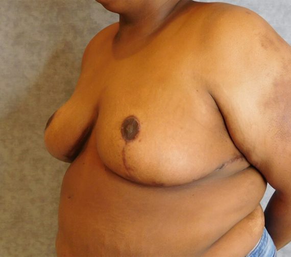 Breast Reduction Patient 05 After