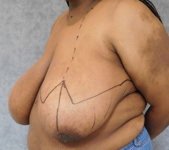 Breast Reduction Patient 05 Before