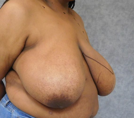 Breast Reduction Patient 05 Before