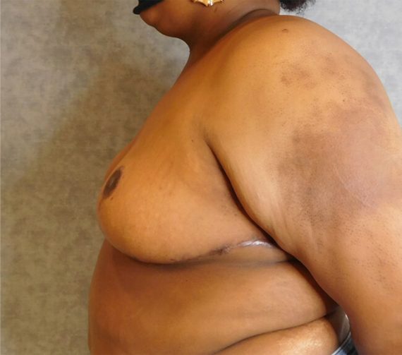 Breast Reduction Patient 05 After