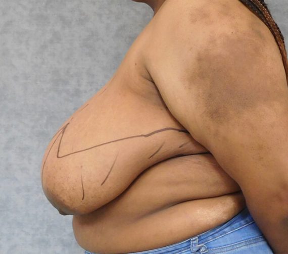 Breast Reduction Patient 05 Before