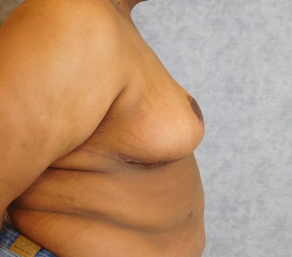 Breast Reduction Patient 05 After