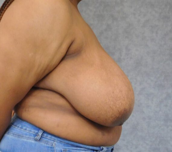Breast Reduction Patient 05 Before