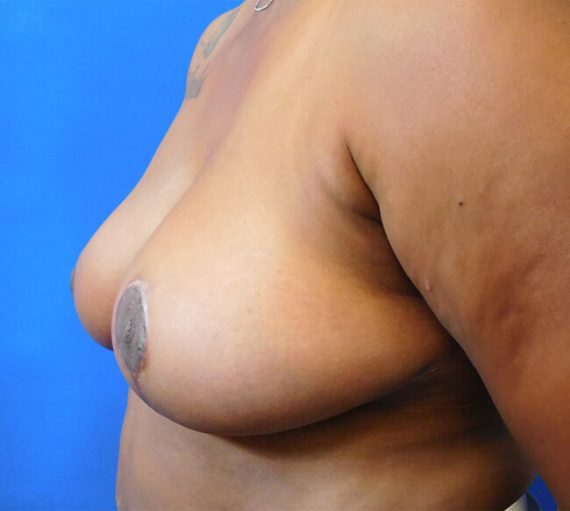 Breast Reduction Patient 06 After