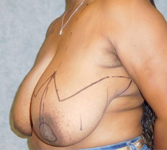 Breast Reduction Patient 06 Before