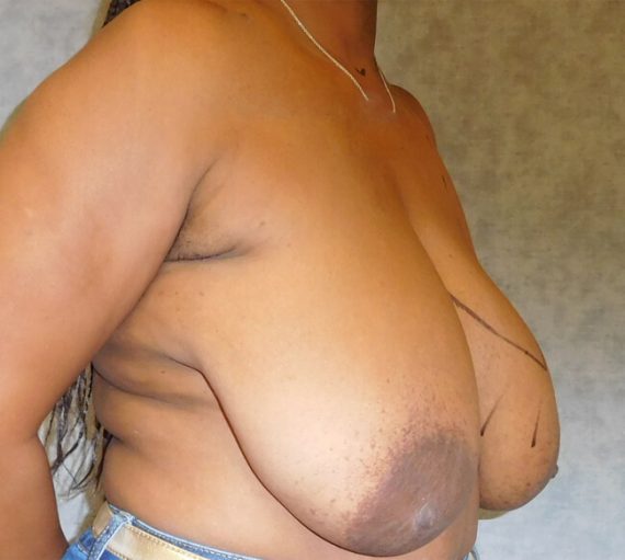 Breast Reduction Patient 06 Before