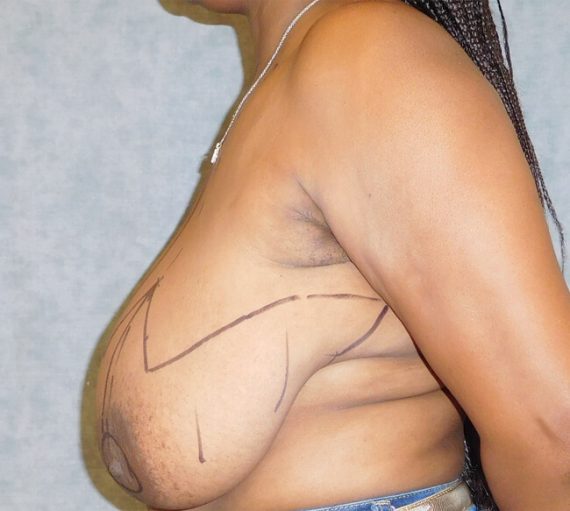 Breast Reduction Patient 06 Before