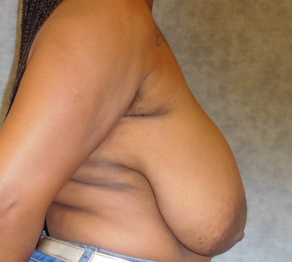 Breast Reduction Patient 06 Before