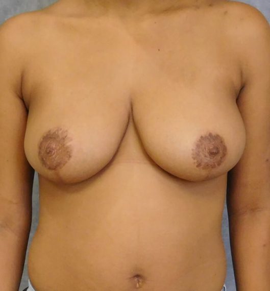 Breast Reduction Patient 07 After