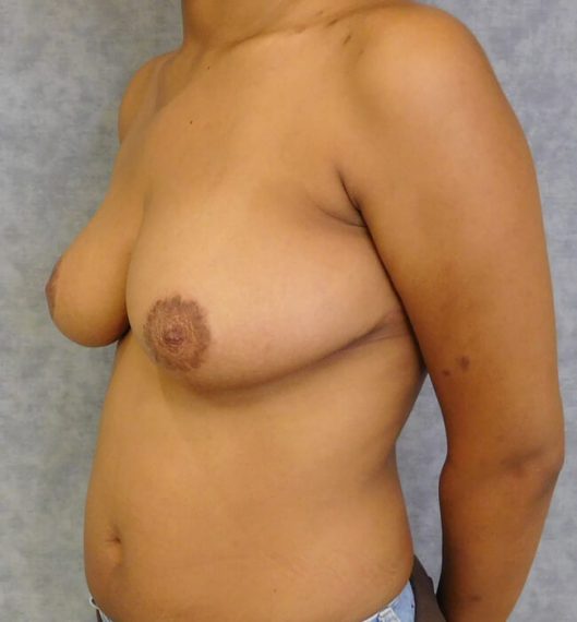 Breast Reduction Patient 07 After
