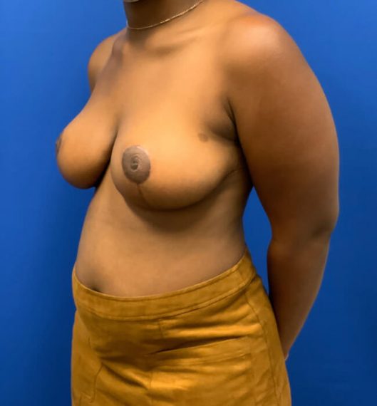 Breast Reduction Patient 08 After