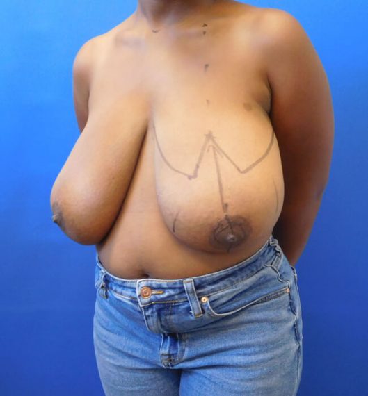 Breast Reduction Patient 08 Before