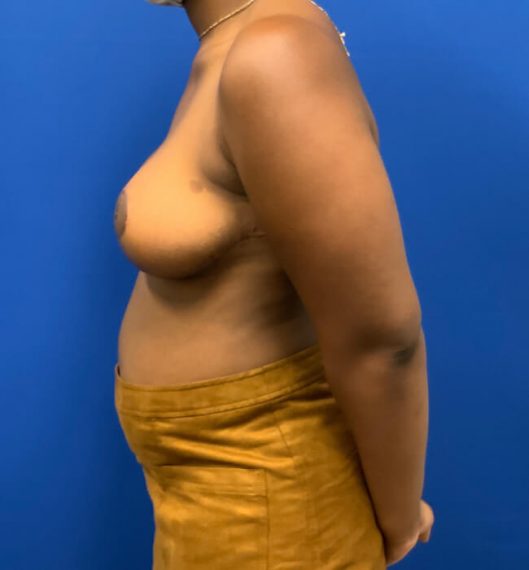 Breast Reduction Patient 08 After