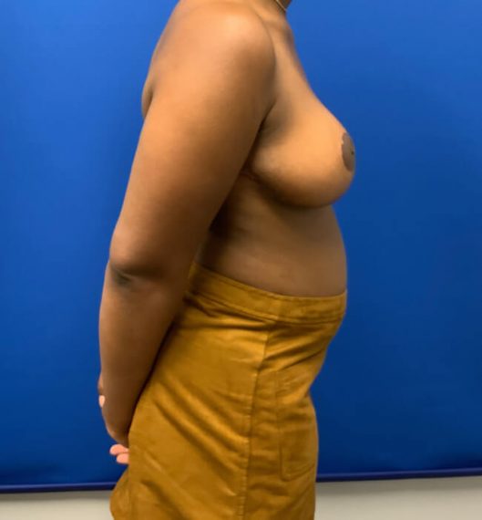 Breast Reduction Patient 08 After
