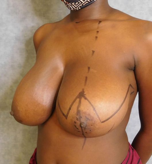 Breast Reduction Patient 09 Before