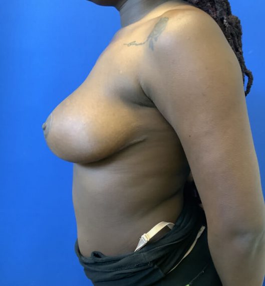Breast Reduction Patient 09 After