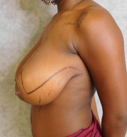 Breast Reduction Patient 09 Before