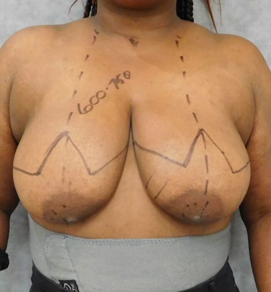 Breast Reduction Patient 10 Before