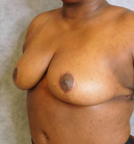 Breast Reduction Patient 10 After