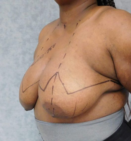 Breast Reduction Patient 10 Before