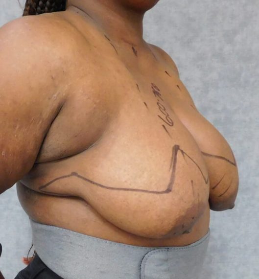 Breast Reduction Patient 10 Before