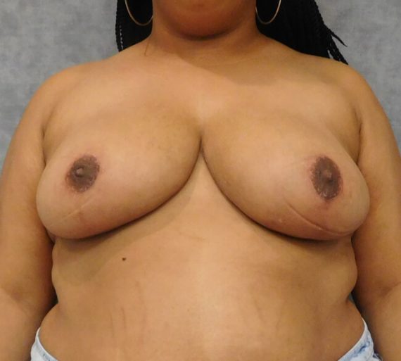 Breast Reduction Patient 11 After