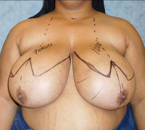 Breast Reduction Patient 11 Before