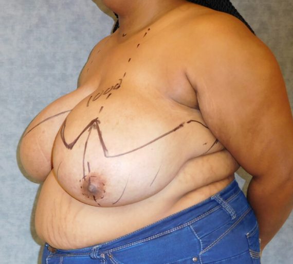 Breast Reduction Patient 11 Before