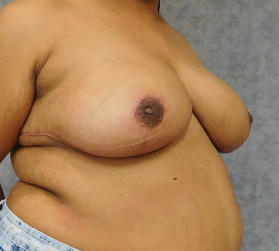 Breast Reduction Patient 11 After