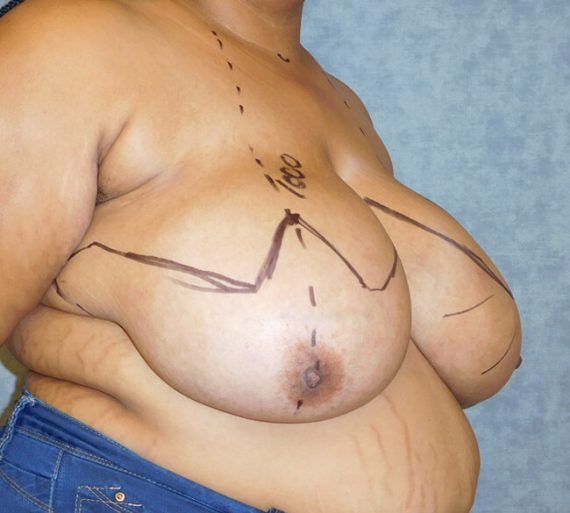 Breast Reduction Patient 11 Before